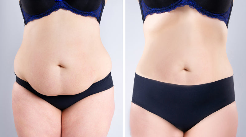 Bauch vorher nachher foto